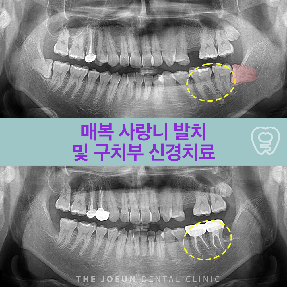 호산동사랑니발치 매복 사랑니 발치 및 구치부 신경치료 - 강창더좋은치과 블로그 | 호산동치과