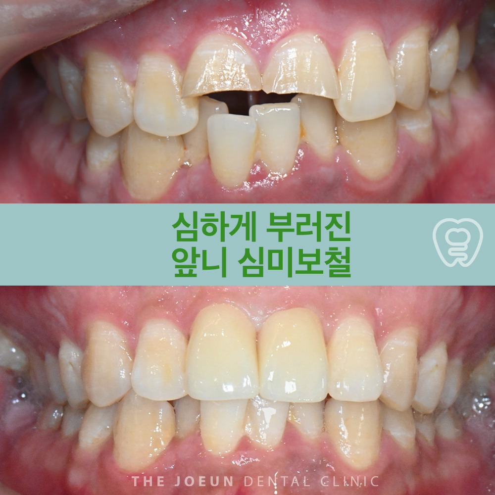 성서심미보철