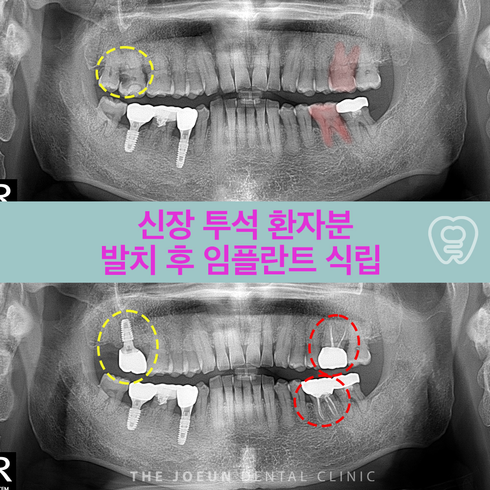 대실역임플란트추천