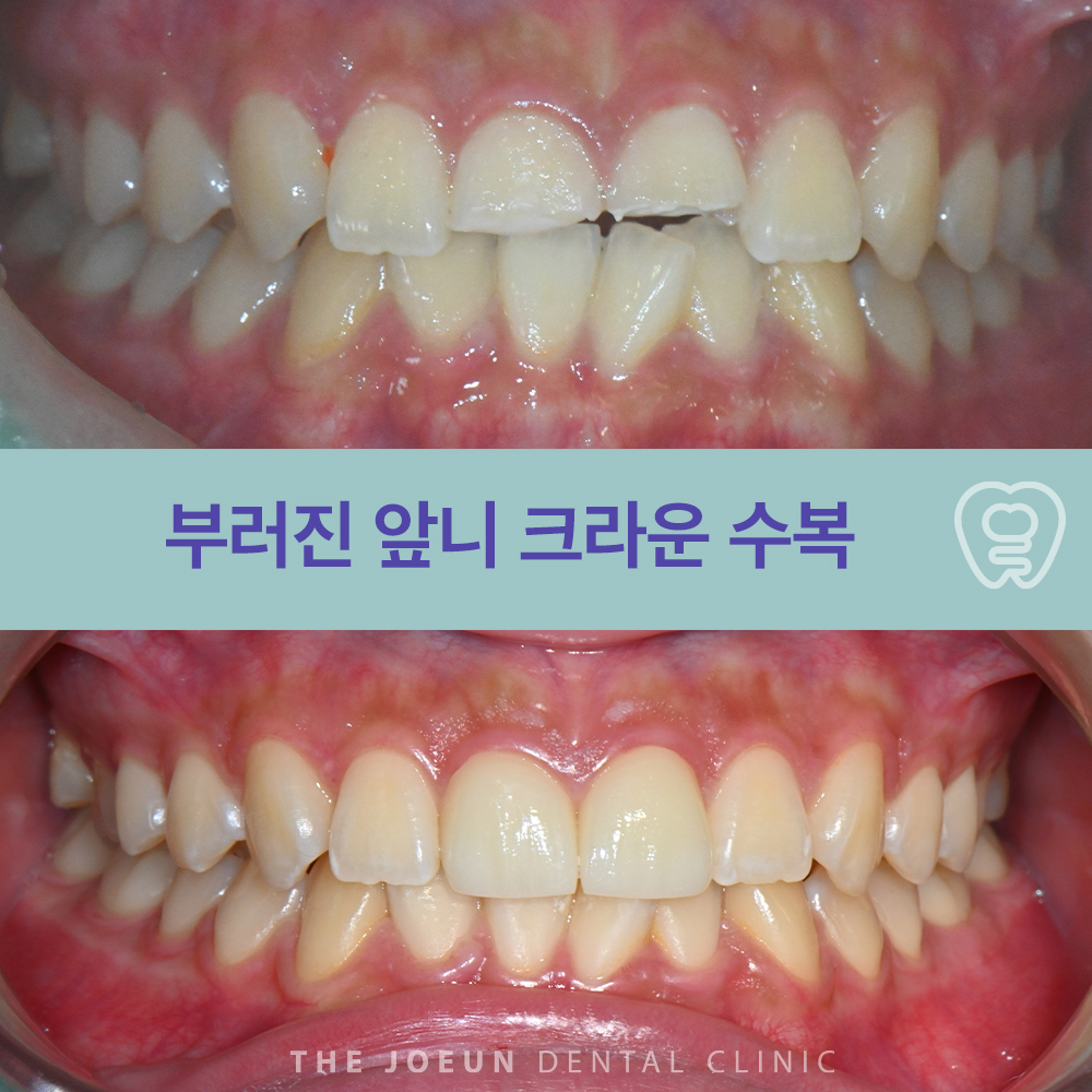 달서구앞니치료