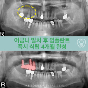 서재임플란트