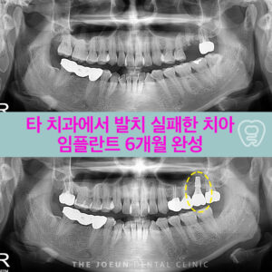 다사임플란트