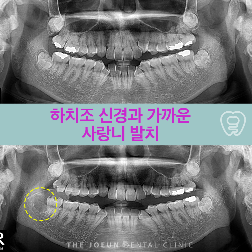 계명대치과 하치조 신경과 가까운 사랑니 발치 - 강창더좋은치과 블로그 | 호산동치과